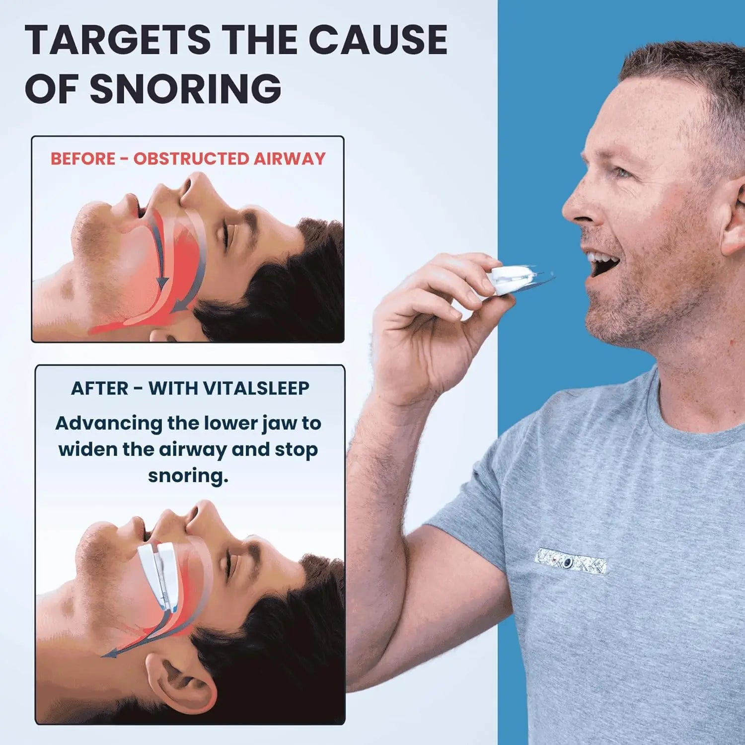 Adjustable Anti-Snoring Mouthpiece
